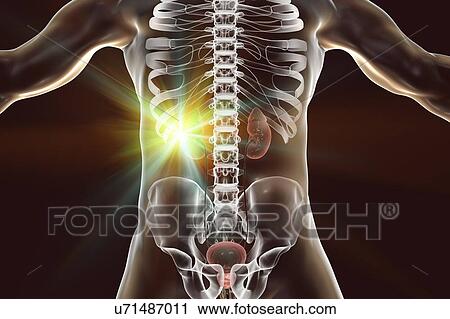Stock Image - Kidney cancer treatment, conceptual computer illustration.. Fotosearch