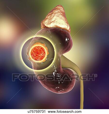Kidney cancer treatment, conceptual computer illustration. View Large Photo Image Stock Image - Kidney cancer treatment, conceptual computer illustration.. Fotosearch