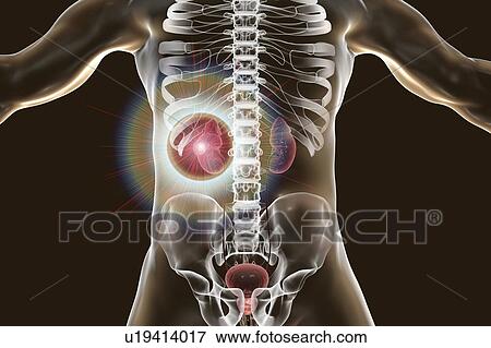 Stock Photo - Kidney cancer treatment, conceptual computer illustration.. Fotosearch