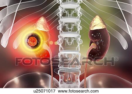 Stock Photo - Kidney cancer treatment, conceptual computer illustration.. Fotosearch