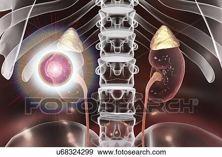Stock Photo - Kidney cancer treatment, conceptual computer illustration.. Fotosearch