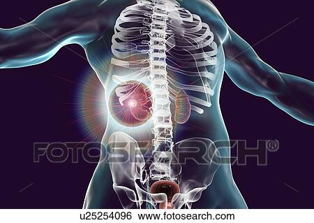 Stock Photograph - Kidney cancer treatment, conceptual computer illustration.. Fotosearch