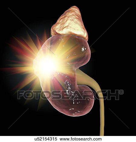 Stock Photography - Kidney cancer treatment, conceptual computer illustration.. Fotosearch