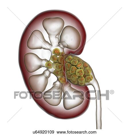 Stock Photo - Kidney stones. Computer illustration showing a section through a human kidney containing kidney stones (yellowish, right). The ureter (lower centre) that carries urine from the kidney to the bladder can also be seen. Kidney stones are solid.... Fotosearch