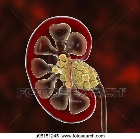 Stock Photography - Kidney stones. Computer illustration showing a section through a human kidney containing kidney stones (yellowish, right). The ureter (lower centre) that carries urine from the kidney to the bladder can also be seen. Kidney stones are solid.... Fotosearch