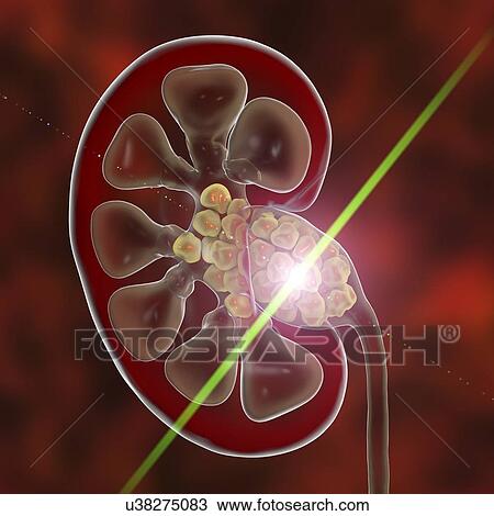 Lithotripsy kidney stone treatment, conceptual illustration. Kidney stones are deposits of calcium and other minerals in the kidneys and ureters. They can be treated by breaking up the stones using pulses of ultrasound. View Large Photo Image Stock Image - Lithotripsy kidney stone treatment, conceptual illustration. Kidney stones are deposits of calcium and other minerals in the kidneys and ureters. They can be treated by breaking up the stones using pulses of ultrasound.. Fotosearch