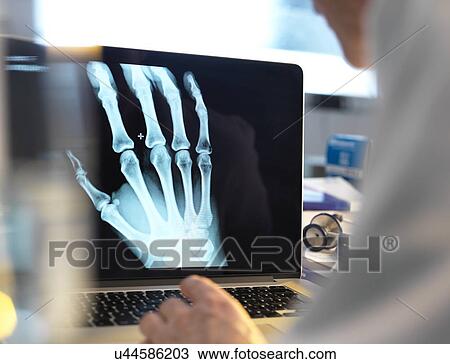 MODEL RELEASED. Doctor viewing an X-ray of a hand on a computer screen. View Large Photo Image Stock Image - MODEL RELEASED. Doctor viewing an X-ray of a hand on a computer screen.. Fotosearch