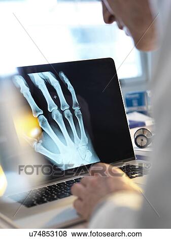 Stock Photo - MODEL RELEASED. Doctor viewing an X-ray of a hand on a computer screen.. Fotosearch