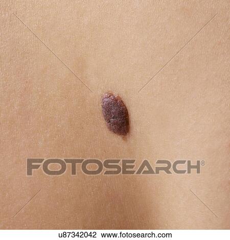 Stock Image - Mole on skin, close up.. Fotosearch