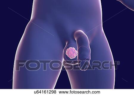 Testicular cancer, computer illustration. View Large Photo Image Stock Photo - Testicular cancer, computer illustration.. Fotosearch