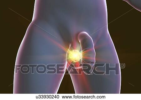Testicular cancer treatment and prevention, conceptual illustration. View Large Photo Image Stock Image - Testicular cancer treatment and prevention, conceptual illustration.. Fotosearch