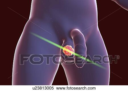 Stock Photography - Testicular cancer treatment and prevention, conceptual illustration.. Fotosearch