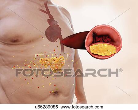 Stock Photography - Visceral fat and heart disease, illustration. Visceral fat is highly hormonally active. It raises the LDL-level in the blood causing a higher risk of atherosclerosis, the build up of fatty plaques in arteries, which can lead to heart disease.. Fotosearch