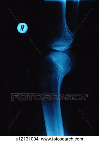 Picture - X-ray of human knee.. Fotosearch