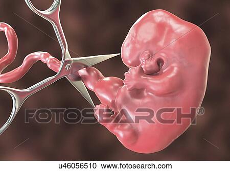 Abortion, conceptual illustration. Medical instrument cutting the umbilical cord to an embryo. View Large Photo Image Stock Image - Abortion, conceptual illustration. Medical instrument cutting the umbilical cord to an embryo.. Fotosearch