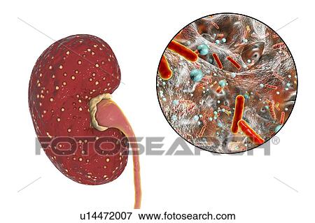 Acute pyelonephritis. Illustration of small abscesses (yellow) on the surface of a kidney in a case of acute pyelonephritis. Bacteria, the causative agents of acute pyelonephritis, are seen in close-up. Pyelonephritis may be either acute or chronic.... View Large Photo Image Stock Photo - Acute pyelonephritis. Illustration of small abscesses (yellow) on the surface of a kidney in a case of acute pyelonephritis. Bacteria, the causative agents of acute pyelonephritis, are seen in close-up. Pyelonephritis may be either acute or chronic..... Fotosearch