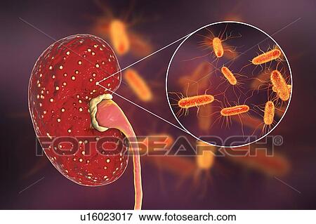 Stock Photo - Acute pyelonephritis. Illustration of small abscesses (yellow) on the surface of a kidney in a case of acute pyelonephritis. Bacteria, the causative agents of acute pyelonephritis, are seen in close-up. Pyelonephritis may be either acute or chronic..... Fotosearch