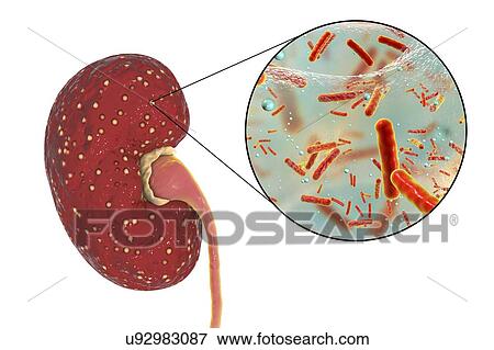 Stock Photo - Acute pyelonephritis. Illustration of small abscesses (yellow) on the surface of a kidney in a case of acute pyelonephritis. Bacteria, the causative agents of acute pyelonephritis, are seen in close-up. Pyelonephritis may be either acute or chronic..... Fotosearch