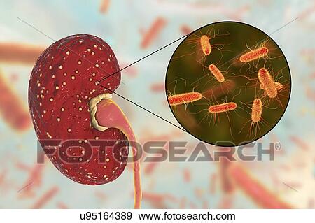 Stock Photo - Acute pyelonephritis. Illustration of small abscesses (yellow) on the surface of a kidney in a case of acute pyelonephritis. Bacteria, the causative agents of acute pyelonephritis, are seen in close-up. Pyelonephritis may be either acute or chronic..... Fotosearch