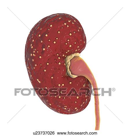 Stock Photograph - Acute pyelonephritis. Illustration of small abscesses (yellow) on the surface of a kidney in a case of acute pyelonephritis. Pyelonephritis may be either acute or chronic. The acute form is usually caused when bacteria causing cystitis spread up the.... Fotosearch