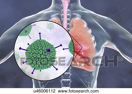 Stock Image - Adenoviruses infecting human lungs, computer illustration. Adenoviruses are DNA-viruses that most commonly infect the upper respiratory tract, eyes and intestine. Occasionally they can cause lower respiratory tract infection (pneumonia), especially in.... Fotosearch