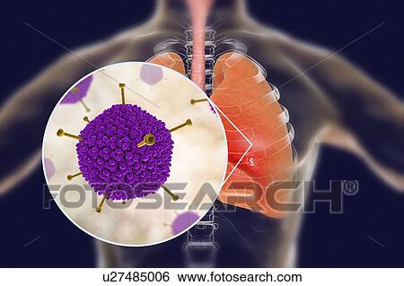 Stock Photograph - Adenoviruses infecting human lungs, computer illustration. Adenoviruses are DNA-viruses that most commonly infect the upper respiratory tract, eyes and intestine. Occasionally they can cause lower respiratory tract infection (pneumonia), especially in.... Fotosearch