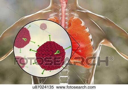 Stock Photography - Adenoviruses infecting human lungs, computer illustration. Adenoviruses are DNA-viruses that most commonly infect the upper respiratory tract, eyes and intestine. Occasionally they can cause lower respiratory tract infection (pneumonia), especially in.... Fotosearch