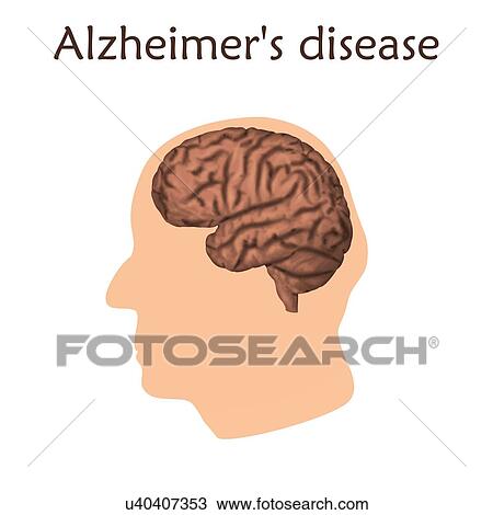 Stock Image - Alzheimer's disease, illustration. Damaged old man's brain.. Fotosearch