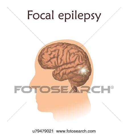 Stock Image - Alzheimer's disease, illustration. Comparison of a normal aged brain and the brain of a person with Alzheimer's.. Fotosearch