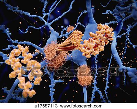 Amyloid protein in Alzheimer's disease. Illustration of the processes leading to the formation of amyloid plaques (tangled bundles) on neurons (nerve cells, blue). Amyloid plaques are characteristic features of Alzheimer's disease. They lead to... View Large Photo Image Stock Image - Amyloid protein in Alzheimer's disease. Illustration of the processes leading to the formation of amyloid plaques (tangled bundles) on neurons (nerve cells, blue). Amyloid plaques are characteristic features of Alzheimer's disease. They lead to.... Fotosearch