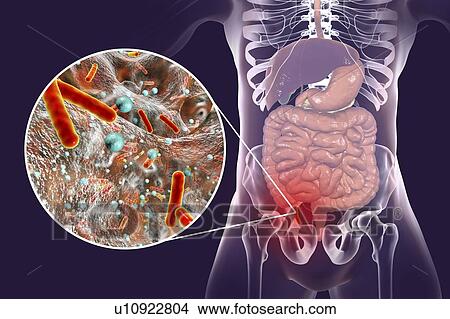 Appendicitis. Illustration of a human appendix, showing it red and inflamed in appendicitis and a close-up view of bacteria, the causative agents of appendicitis. The most common microorganisms recovered from appendix with acute appendicitis are... View Large Photo Image Picture - Appendicitis. Illustration of a human appendix, showing it red and inflamed in appendicitis and a close-up view of bacteria, the causative agents of appendicitis. The most common microorganisms recovered from appendix with acute appendicitis are.... Fotosearch