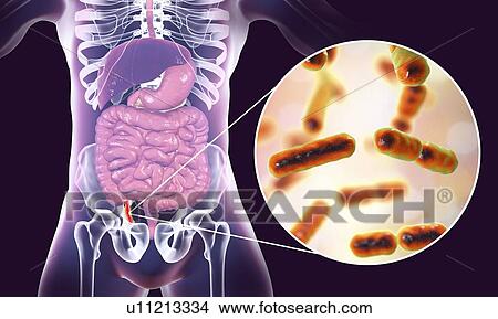 Picture - Appendicitis. Illustration of a human appendix, showing it red and inflamed in appendicitis and a close-up view of bacteria, the causative agents of appendicitis. Bacteroides sp. are one of the common anaerobic causative agents of acute and chronic.... Fotosearch
