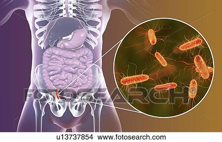 Picture - Appendicitis. Illustration of a human appendix, showing it red and inflamed in appendicitis and a close-up view of bacteria, the causative agents of appendicitis. Gram-negative rod-shaped bacterium Escherichia coli is the commonest causative agent of.... Fotosearch
