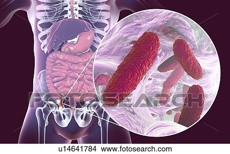 Picture - Appendicitis. Illustration of a human appendix, showing it red and inflamed in appendicitis and a close-up view of bacteria, the causative agents of appendicitis. Rod-shaped bacterium Klebsiella pneumoniae is one of the causative agents of acute and.... Fotosearch