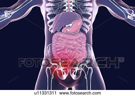 Stock Image - Appendicitis. Illustration of a human appendix, showing it red and inflamed in appendicitis. The appendix is a narrow finger-shaped tube that branches off the first part of the large intestine (caecum). Inflammation of the appendix in appendicitis is.... Fotosearch