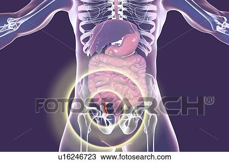 Stock Image - Appendicitis. Illustration of a human appendix, showing it red and inflamed in appendicitis. The appendix is a narrow finger-shaped tube that branches off the first part of the large intestine (caecum). Inflammation of the appendix in appendicitis is.... Fotosearch