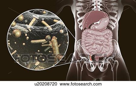 Appendicitis. Illustration of a human appendix, showing it red and inflamed in appendicitis and a close-up view of bacteria, the causative agents of appendicitis. The most common microorganisms recovered from appendix with acute appendicitis are... View Large Photo Image Stock Image - Appendicitis. Illustration of a human appendix, showing it red and inflamed in appendicitis and a close-up view of bacteria, the causative agents of appendicitis. The most common microorganisms recovered from appendix with acute appendicitis are.... Fotosearch