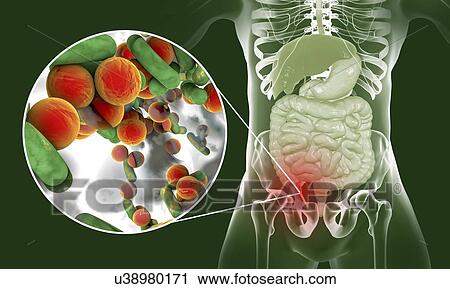 Stock Image - Appendicitis. Illustration of a human appendix, showing it red and inflamed in appendicitis and a close-up view of bacteria, the causative agents of appendicitis. The most common microorganisms recovered from appendix with acute appendicitis are.... Fotosearch