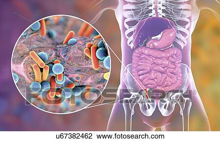 Stock Image - Appendicitis. Illustration of a human appendix, showing it red and inflamed in appendicitis and a close-up view of bacteria, the causative agents of appendicitis. The most common microorganisms recovered from appendix with acute appendicitis are.... Fotosearch