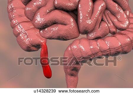 Appendicitis. Illustration of a human appendix, showing it red and inflamed in appendicitis. The appendix is a narrow finger-shaped tube that branches off the first part of the large intestine (caecum). Inflammation of the appendix in appendicitis is... View Large Photo Image Stock Photo - Appendicitis. Illustration of a human appendix, showing it red and inflamed in appendicitis. The appendix is a narrow finger-shaped tube that branches off the first part of the large intestine (caecum). Inflammation of the appendix in appendicitis is.... Fotosearch