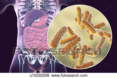 Stock Photo - Appendicitis. Illustration of a human appendix, showing it red and inflamed in appendicitis and a close-up view of bacteria, the causative agents of appendicitis. The most common microorganisms recovered from appendix with acute appendicitis are.... Fotosearch