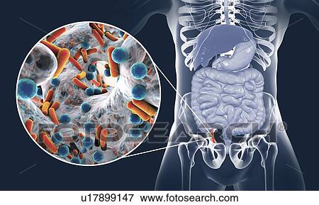 Stock Photo - Appendicitis. Illustration of a human appendix, showing it red and inflamed in appendicitis and a close-up view of bacteria, the causative agents of appendicitis. The most common microorganisms recovered from appendix with acute appendicitis are.... Fotosearch