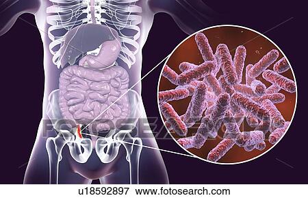 Stock Photo - Appendicitis. Illustration of a human appendix, showing it red and inflamed in appendicitis and a close-up view of bacteria, the causative agents of appendicitis. Bacteria of Enterobacteriaceae family, such as Escherichia coli, Klebsiella, Citrobacter.... Fotosearch