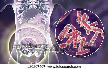 Stock Photo - Appendicitis. Illustration of a human appendix, showing it red and inflamed in appendicitis and a close-up view of bacteria, the causative agents of appendicitis. The most common microorganisms recovered from appendix with acute appendicitis are.... Fotosearch