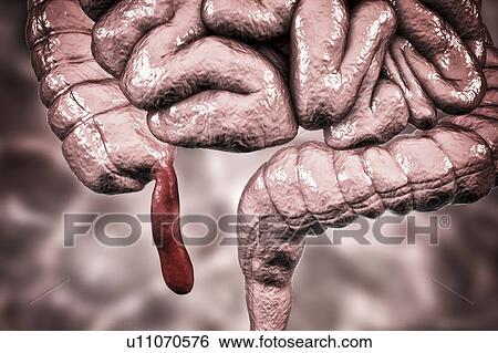 Stock Photograph - Appendicitis. Illustration of a human appendix, showing it red and inflamed in appendicitis. The appendix is a narrow finger-shaped tube that branches off the first part of the large intestine (caecum, left). Inflammation of the appendix in.... Fotosearch