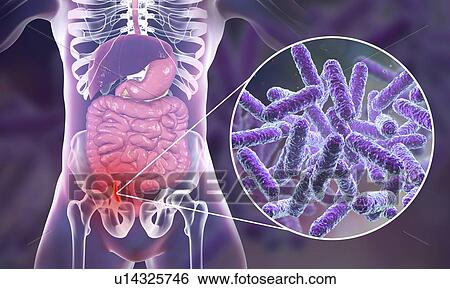 Stock Photograph - Appendicitis. Illustration of a human appendix, showing it red and inflamed in appendicitis and a close-up view of bacteria, the causative agents of appendicitis. Bacteria of Enterobacteriaceae family, such as Escherichia coli, Klebsiella, Citrobacter.... Fotosearch