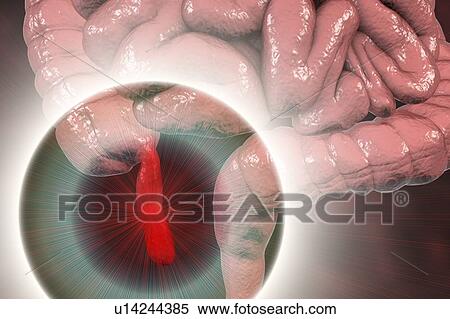 Stock Photography - Appendicitis. Illustration of a human appendix, showing it red and inflamed in appendicitis. The appendix is a narrow finger-shaped tube that branches off the first part of the large intestine (caecum, left). Inflammation of the appendix in.... Fotosearch