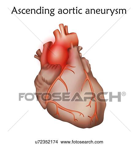 Picture - Ascending aortic aneurysm, illustration. Enlargement of a weakened area in the ascending aorta.. Fotosearch