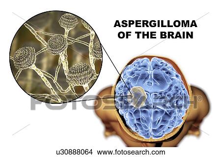 Picture - Aspergilloma of the brain and a close-up view of Aspergillus fungi, computer illustration. Also known as mycetoma, or fungus ball, this is an intracranial lesion produced by Aspergillus fungi in immunocompromised patients.. Fotosearch