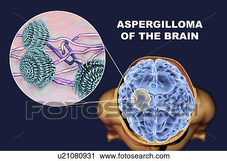 Aspergilloma of the brain and a close-up view of Aspergillus fungi, computer illustration. Also known as mycetoma, or fungus ball, this is an intracranial lesion produced by Aspergillus fungi in immunocompromised patients. View Large Photo Image Stock Image - Aspergilloma of the brain and a close-up view of Aspergillus fungi, computer illustration. Also known as mycetoma, or fungus ball, this is an intracranial lesion produced by Aspergillus fungi in immunocompromised patients.. Fotosearch